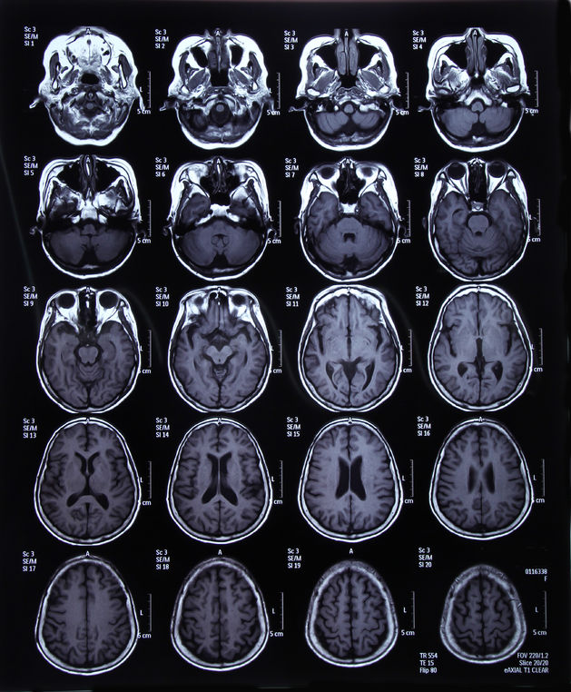 Cara Mengobati Kanker Otak Aman dan Efektif