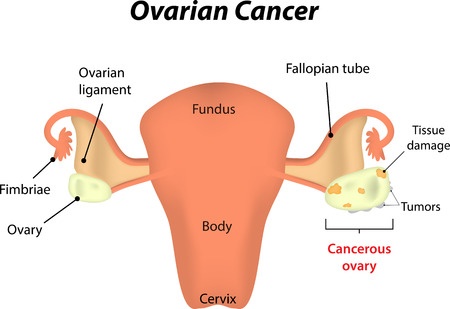 Pengobatan Kanker Ovarium 